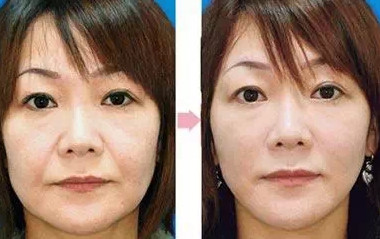 童颜神器爱塑美童颜针微整形行业新宠