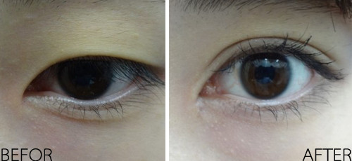 整形科普双眼皮开眼角手术如何避免疤痕增生