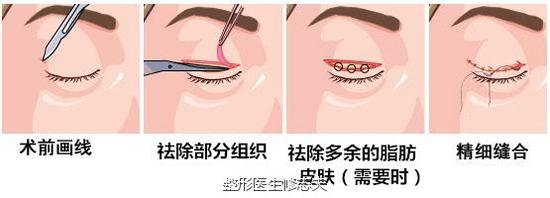 切开法双眼皮