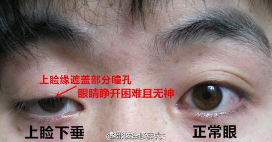 适合人群:上睑下垂,眼睛睁不大,看起来像睡不醒的人最能让眼睛变大变