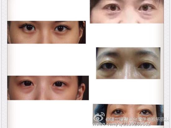 告别咒怨型的泪沟问题 眼下老化问题的新式处理方法 手机新浪网