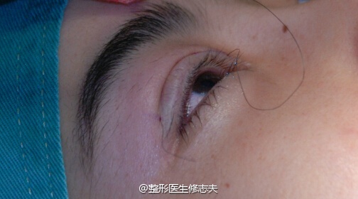 埋线双眼皮美中不足的是,一段时间内埋线线结容易松动