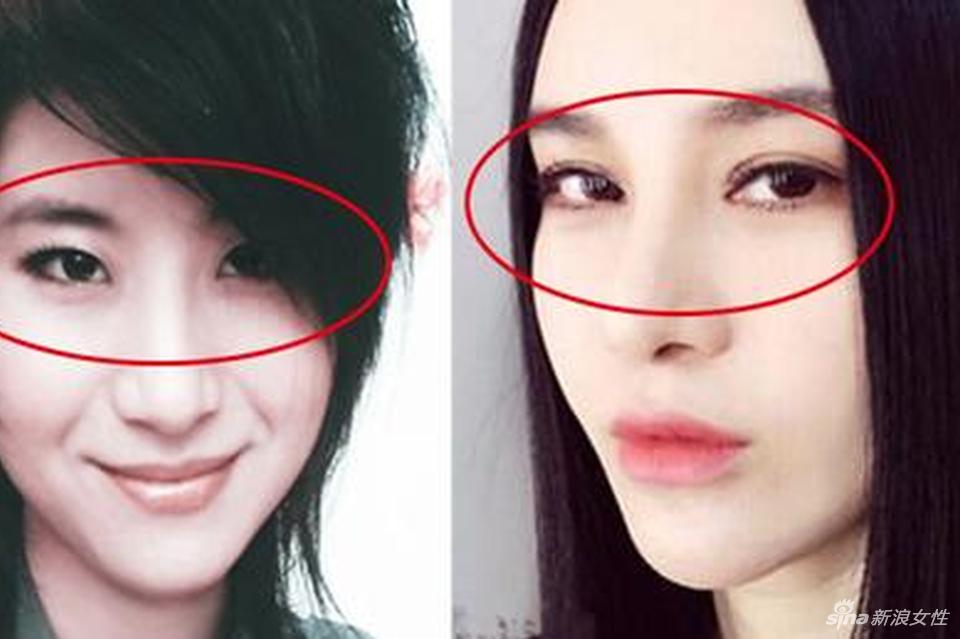 双眼皮对比图