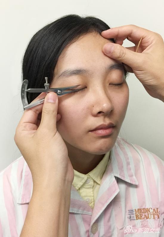 看完双眼皮手术恢复30天全程记录原来变美soeasy