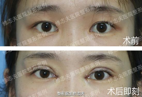内双变外双,就是这么轻松|双眼皮|内双|外双_新浪女性_新浪网