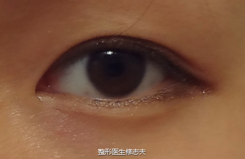 内双变外双,就是这么轻松|双眼皮|内双|外双_新浪女性_新浪网