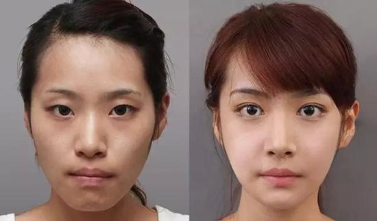 做个双眼皮是一种怎样的感受