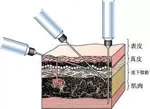 敲黑板,肉毒素除皱应该打到哪,打多深,打多少?