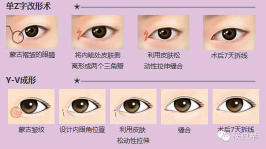开眼角双眼皮需要注意哪些