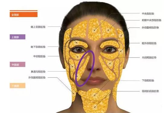 自体脂肪填充鼻唇沟,赶走法令纹年轻十岁