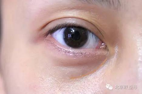 眼袋手术不沟撞皇侵久蝗コ删!是因为有泪沟!