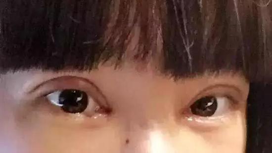 2,双眼皮术后不消肿,出现肉条   有的人割双眼皮半年后,眼睛
