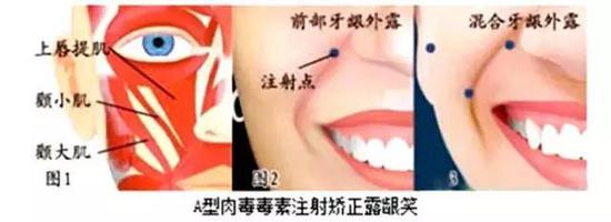 肉毒素注射治疗露龈笑静态时上唇较短,静态及动态情况下有牙龈露出的