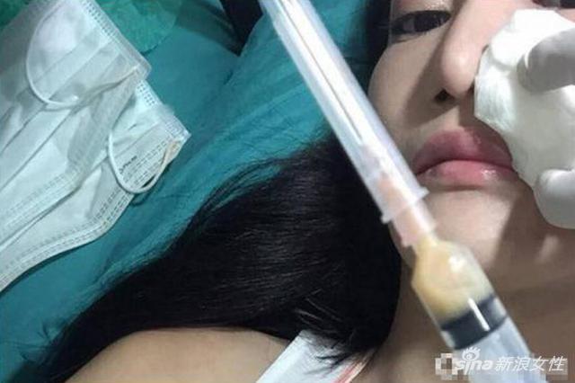 泰国美女连打6年美白针惨遭毁容美白针究竟能不能打