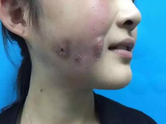 一针毁一生节后你不可选的溶脂针