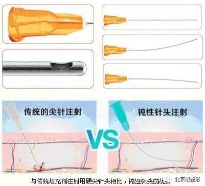 注射玻尿酸,该选钝针还是锐针|玻尿酸|针头|注射_新浪女性_新浪网