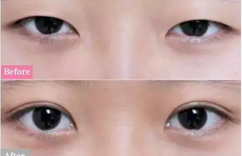 为什么,双眼皮这样做才最漂亮呢?