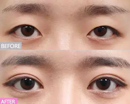 为什么,双眼皮这样做才最漂亮呢?