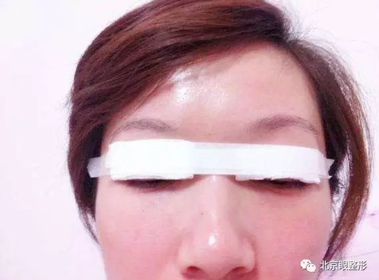 你肯定不知道双眼皮手术后最重要的一点竟然是包扎