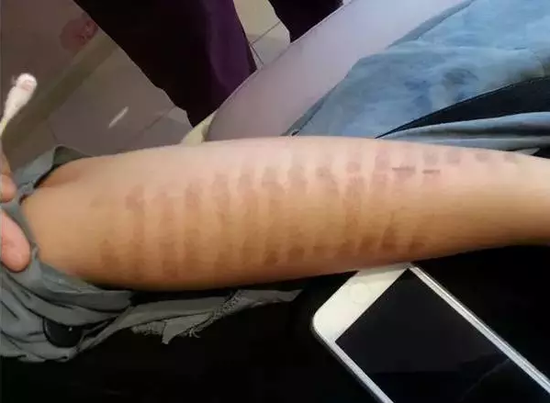 做好舒缓皮肤工作,不管你用什么脱毛方法,都会在一定的程度上对肌肤