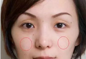 时候苹果肌不明显,或由于颧骨过高而导致苹果肌下陷的,属于苹果肌扁平