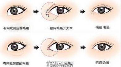 有人说十个开内眼角竟有九个失败的?