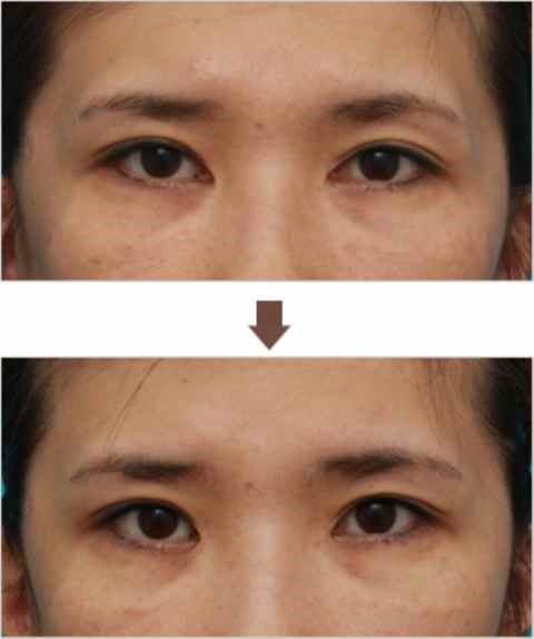 内眼角修复前后的对比图
