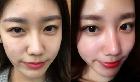 姓名:赵莹 年龄:25岁 职业:主持人痘龄:6年 治疗