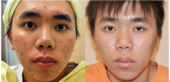 prf祛痘术专业祛除顽固性痘痘