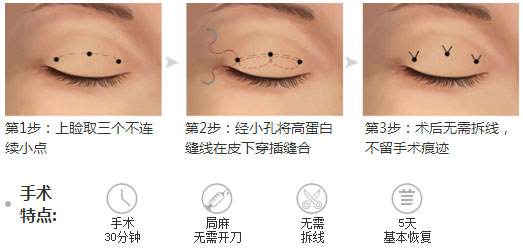 埋线双眼皮术后注意事项|埋线双眼皮|注意事项|上睑_新浪女性_新浪网