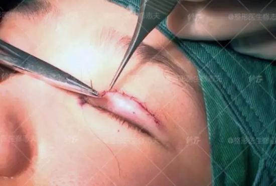 双眼皮手术切口缝合