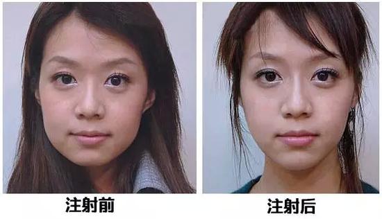 隆下巴之前要打肉毒素还有这样的操作
