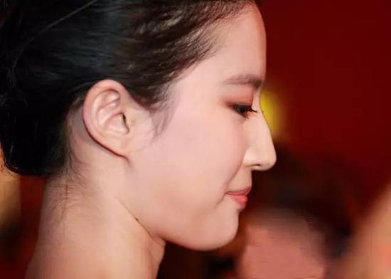 鼻子要好看,只做隆鼻可不够|隆鼻|驼峰|鼻翼_新浪女性_新浪网