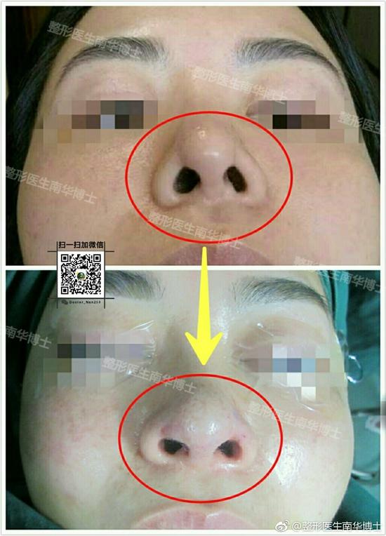 鼻子挛缩是怎么导致的图片