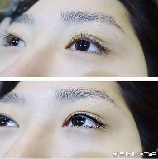 双眼皮整形王海平双眼皮美瞳线你眼睛会放电