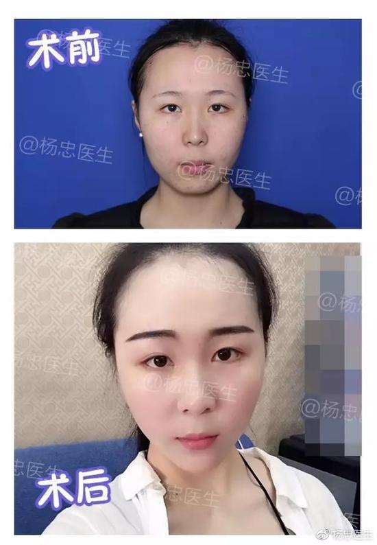 一张图解:为什么明星都爱整下巴?|下巴|假体|隆下巴_新浪女性_新浪网