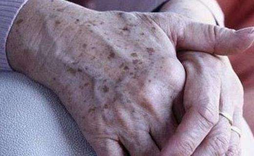 为什么老人大多脸上有斑