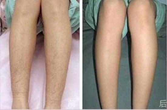 冰点脱腿毛会不会引起身体的不适