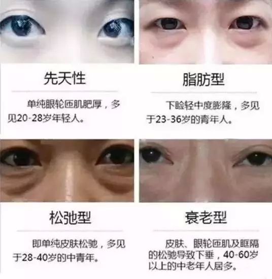 她的眼袋让她看起来老了十岁你的呢