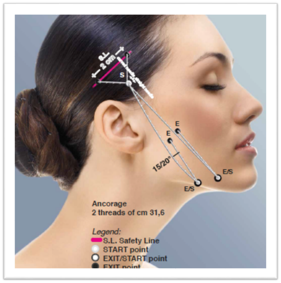 为什么颧弓颧骨高的妹子做完线雕有可能变成梭形脸