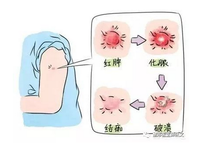 胳膊上有疤痕说明接种了这两种疫苗卡介苗疫苗和牛痘疫苗
