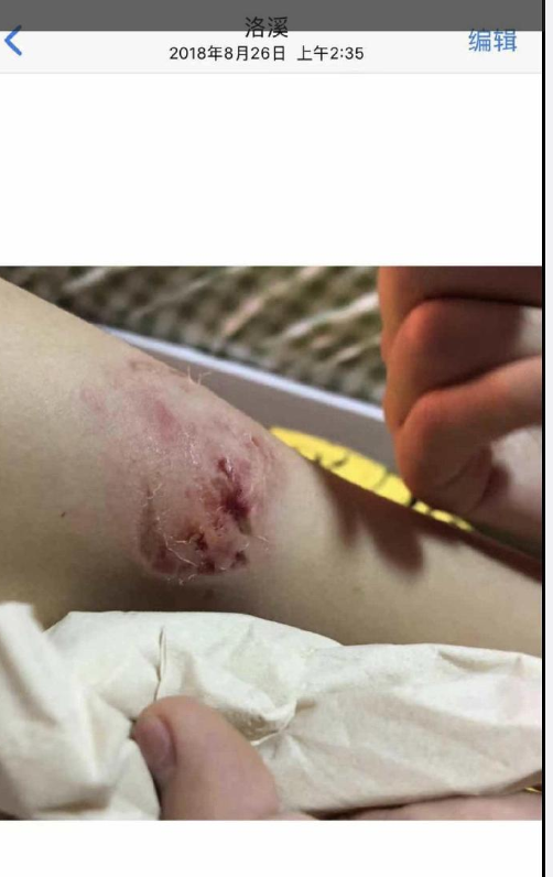 组图:疑似gnz48左婧媛遭唐莉佳家暴 晒照手臂及腿部多处受伤