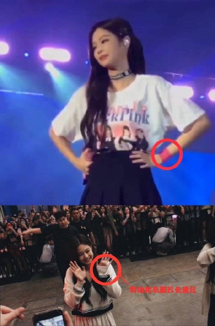 组图：BLACKPINK成员JENNIE受伤手腕淤青 直播安慰粉丝笑称没事