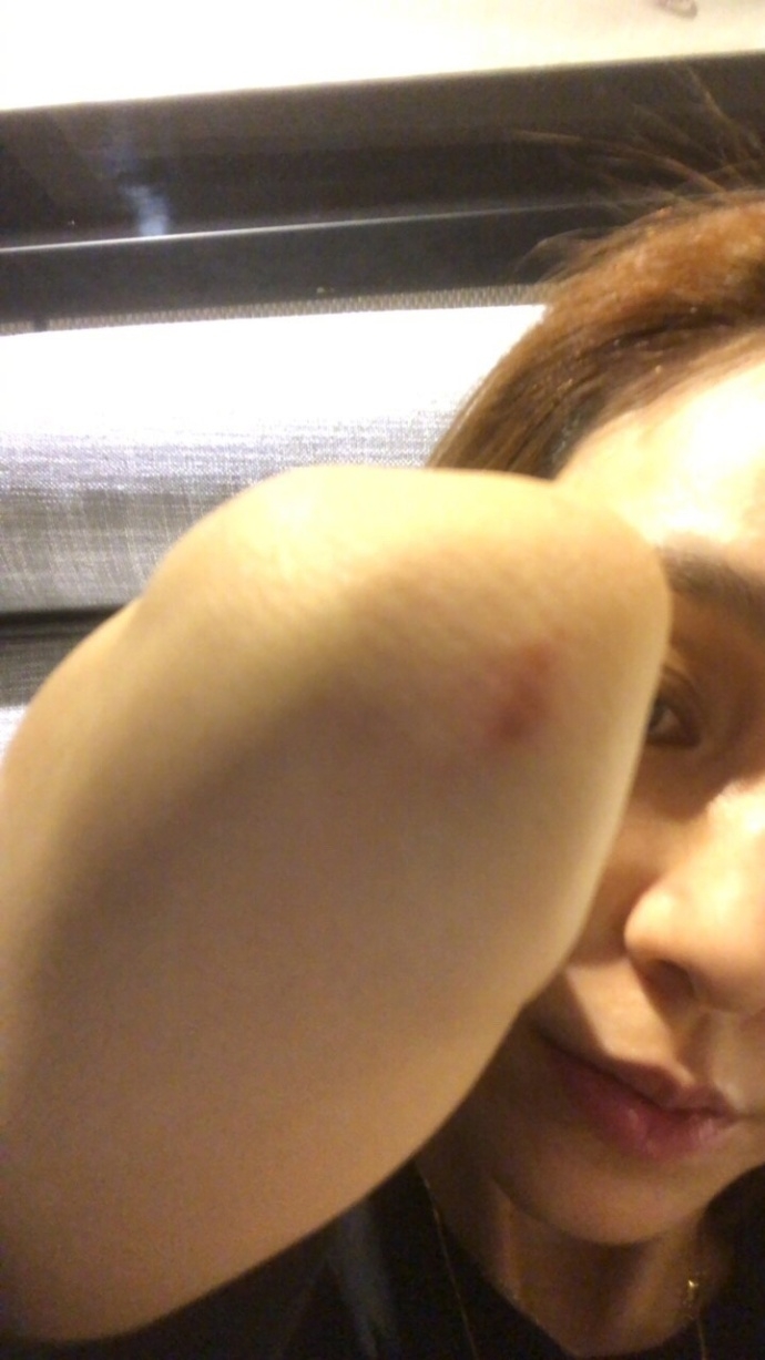 组图范玮琪意外摔倒膝盖受伤红肿淤青伤势不轻