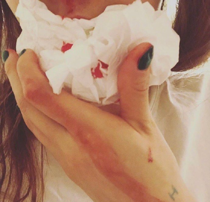 组图泫雅深夜晒下巴受伤照片纸巾布满斑斑血迹