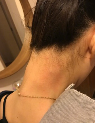 阿娇晒出颈部受伤照