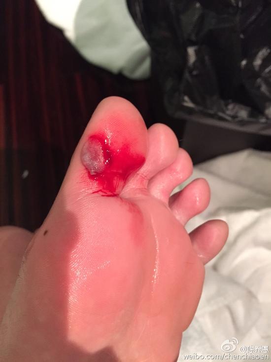 陈乔恩今年摔5个狗吃屎 手脚膝盖全出血|陈乔恩|受伤|膝盖_新浪娱乐