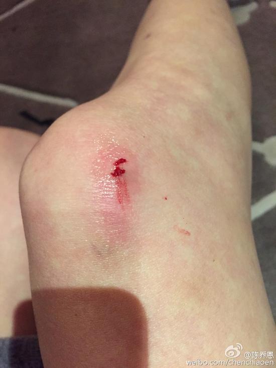 陈乔恩今年摔5个狗吃屎手脚膝盖全出血