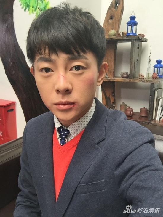 腹黑boy张皓然惨遭毒手 满脸伤痕不忘卖萌
