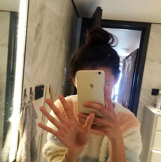 张予曦奇星记杀青打戏受伤手掌淤青